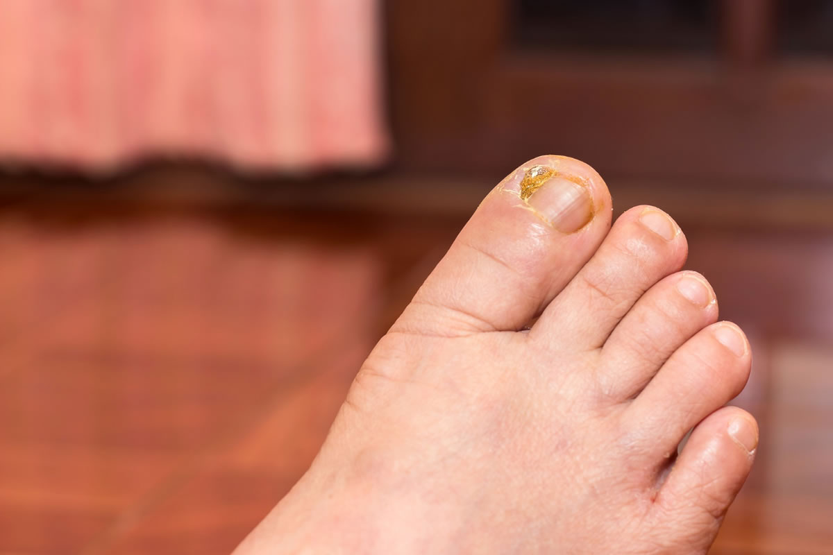 4 Common Foot Problems