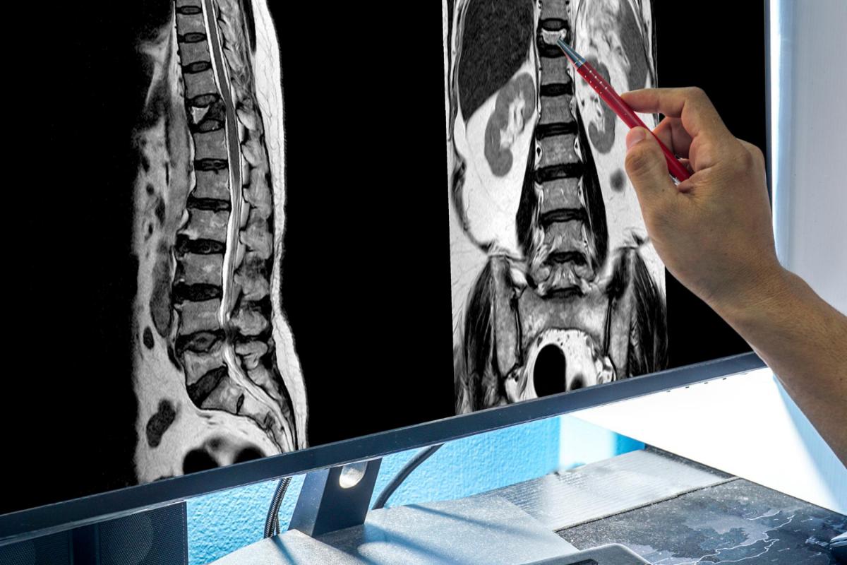 Understanding a lumbar discectomy