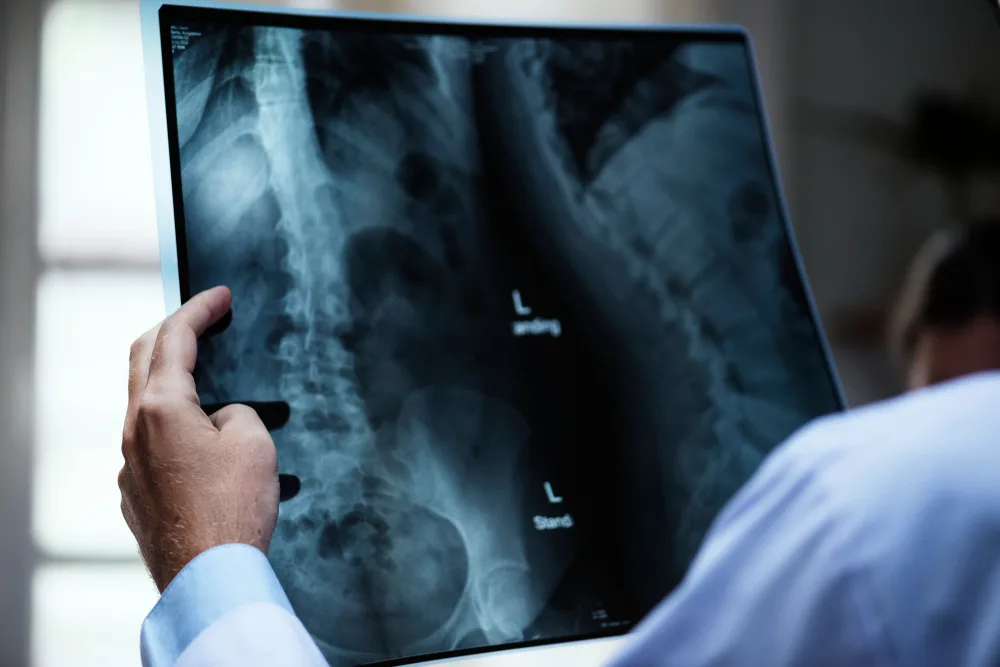 Debunking Common Myths About Discectomy Surgery