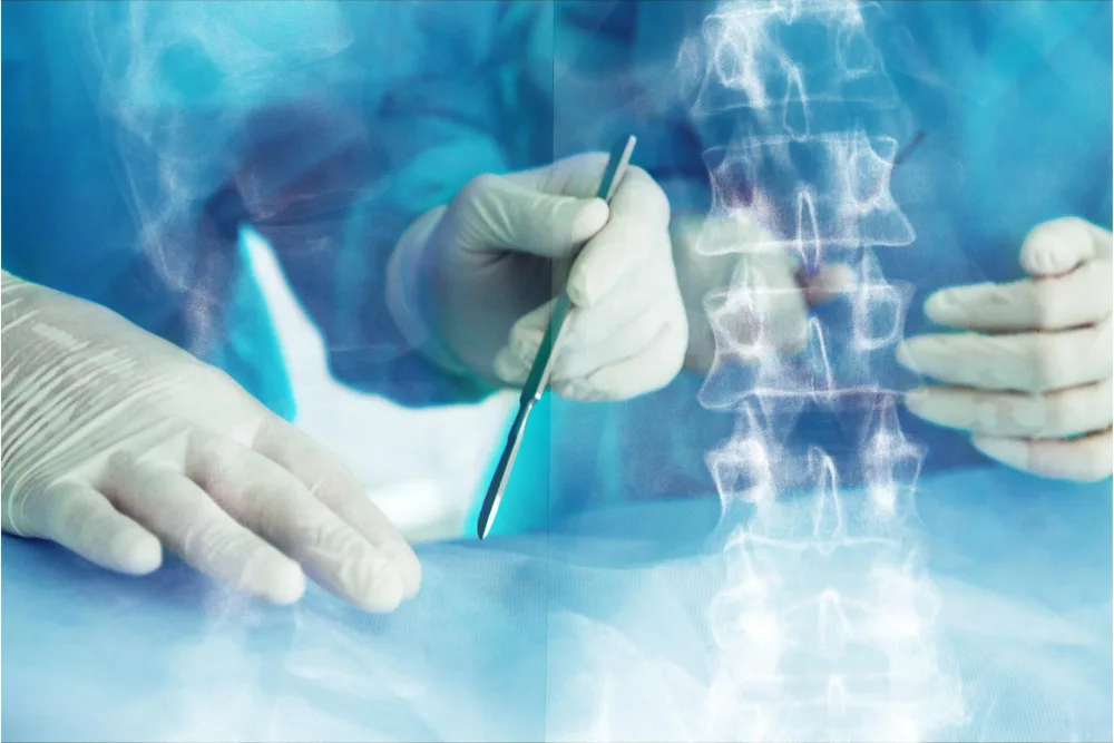 Spinal Fusion Surgery: What Patients Need to Know
