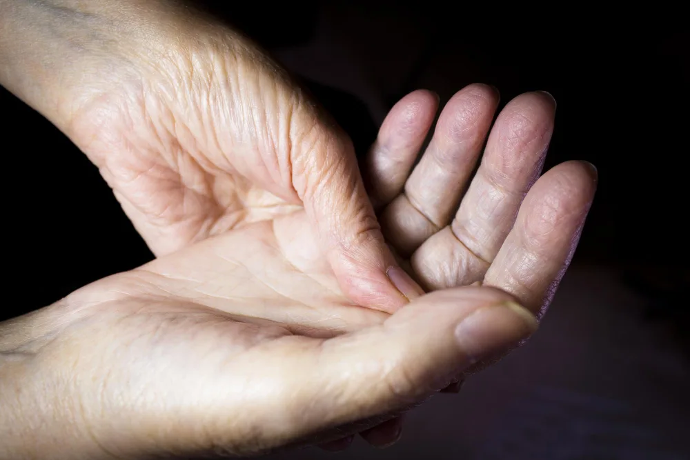 What Is Dupuytren's Contracture?