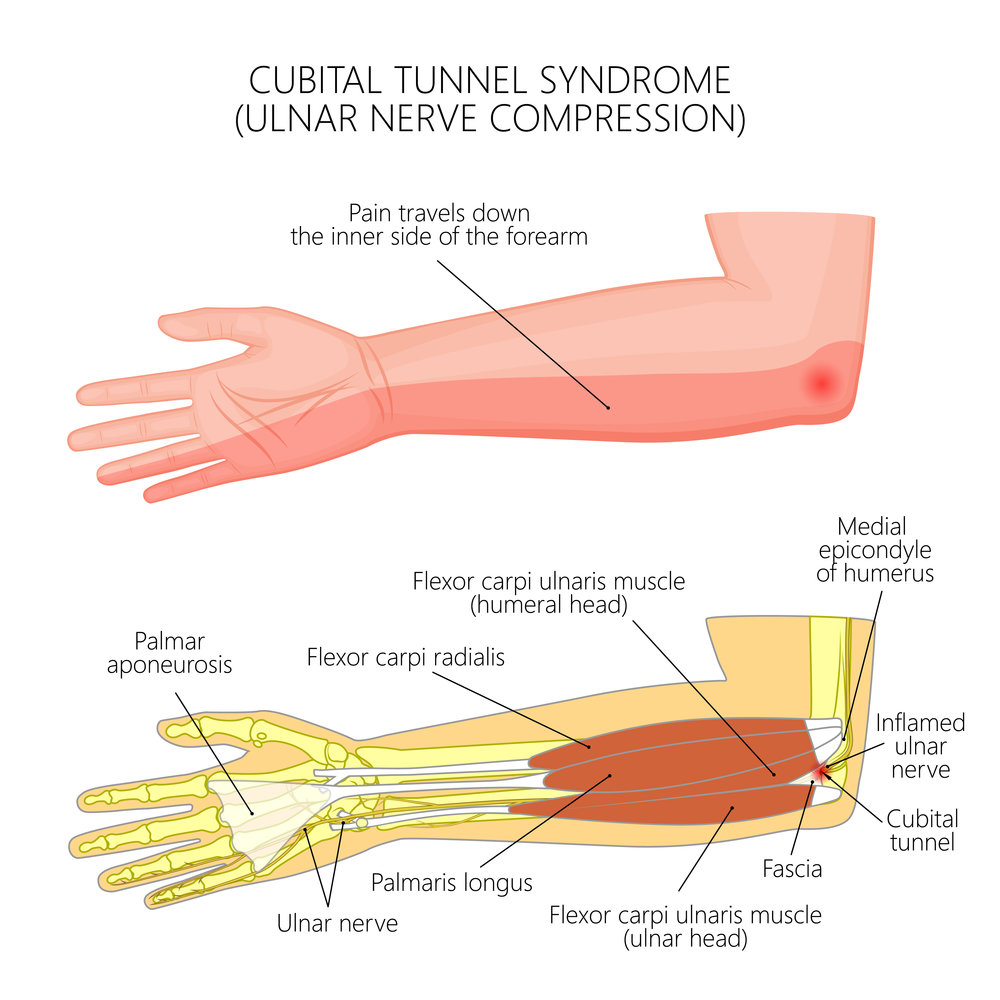 Cubital Tunnel Syndrome - Nonsurgical Options - Orlando Hand Surgery  Associates