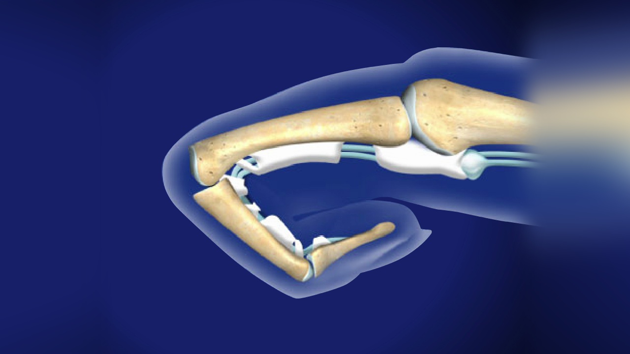 What causes Trigger Finger?