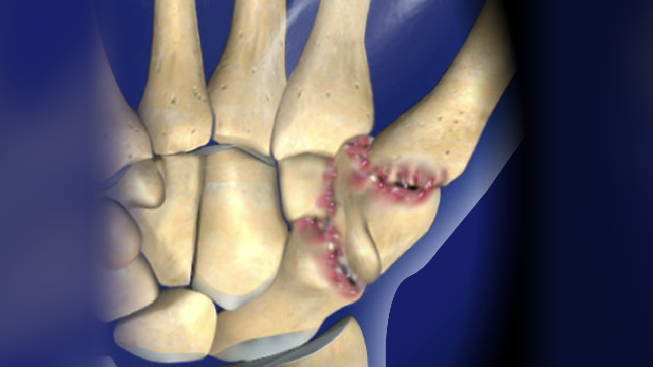 What is thumb CMC arthritis?