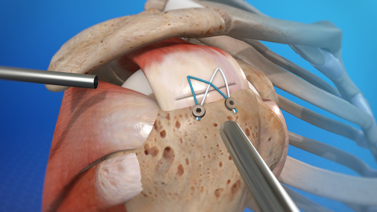 What are the surgical treatments for a rotator cuff tear? 