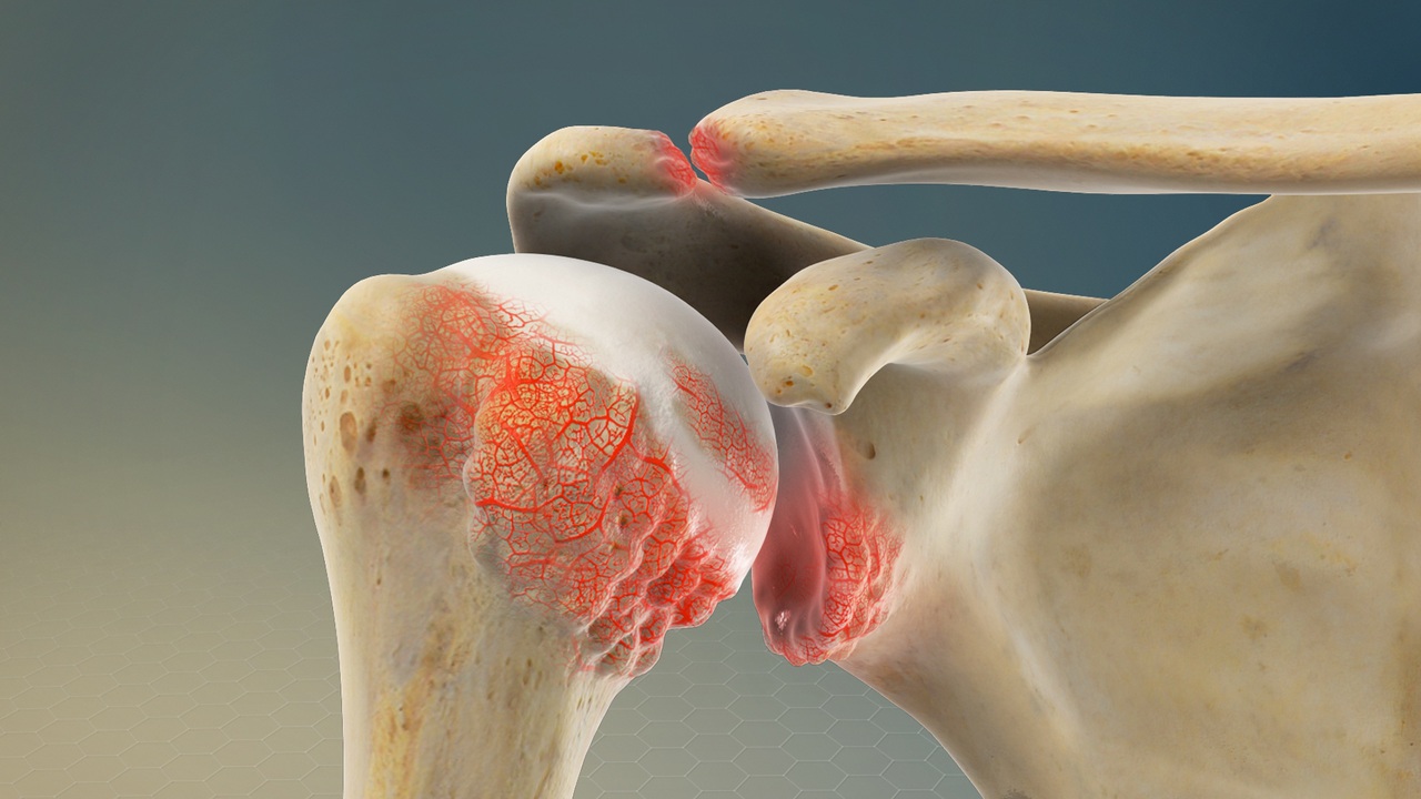 What is Shoulder arthritis?