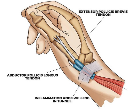 DeQuervain’s tenosynovitis causes