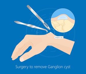 treatments for ganglion cysts