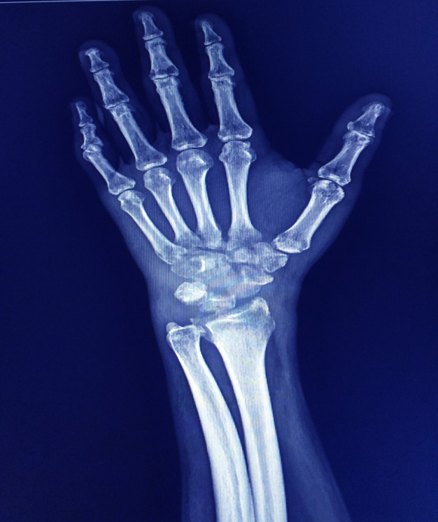 thumb CMC arthritis