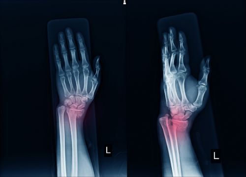 diagnose a wrist fracture