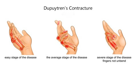 Dupuytren’s disease